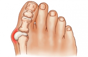 Juanetes (Hallux valgus)