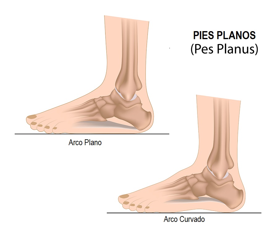 Pies Planos